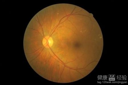 眼底出血引起的黃斑囊腫該如何治療