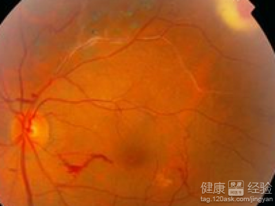 眼底出血治療後血塊一直沒消是怎麼回事