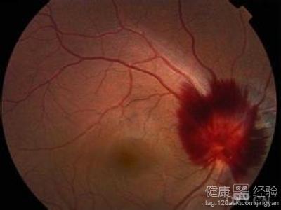 眼底出血怎樣補碘好