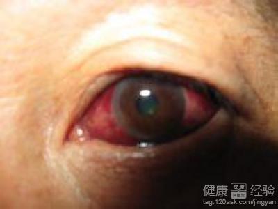外傷性眼底出血治愈後該怎麼護理