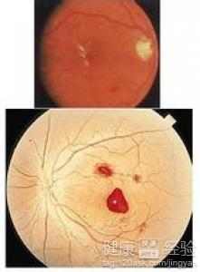 糖尿病誘發眼底出血有什麼好藥