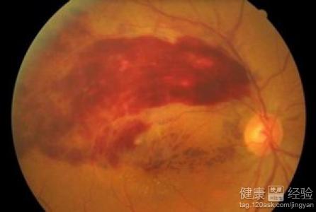 血管脆造成眼底出血的治療方法