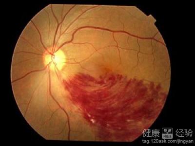 眼底出血的治療經驗