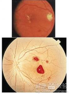 老年人眼底出血要如何護理