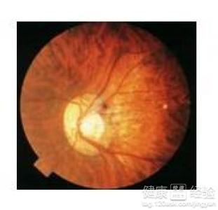 眼底出血做熒光造影和激光治療會引發哪些問題