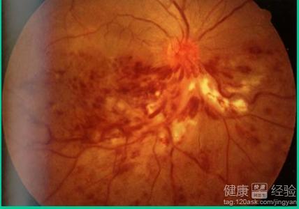 眼底出血用激光術效果好嗎