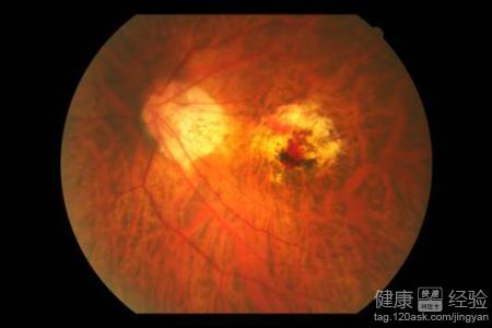 眼底出血用什麼藥治療比較好