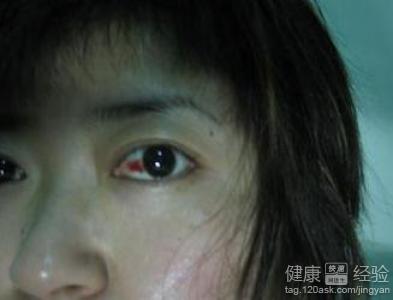 眼底出血視網膜血管炎怎樣治療