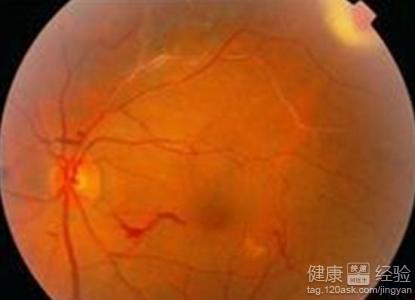 眼底出血引起視網膜脫落能治好嗎