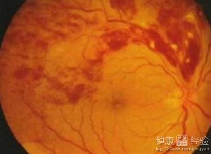 9個月寶寶眼底出血是怎麼回事