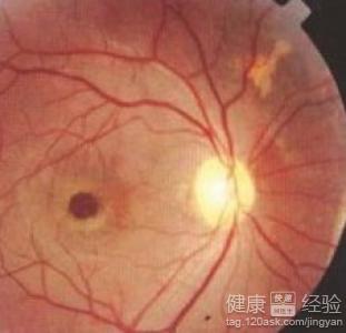 眼底出血導致靜脈阻塞該怎麼辦