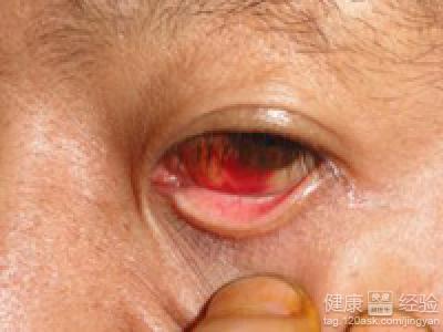 該怎樣預防眼底出血的發生？
