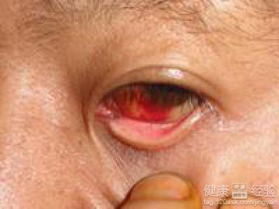 如何來預防眼底出血？