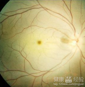 黃斑變性不能吃什麼東西