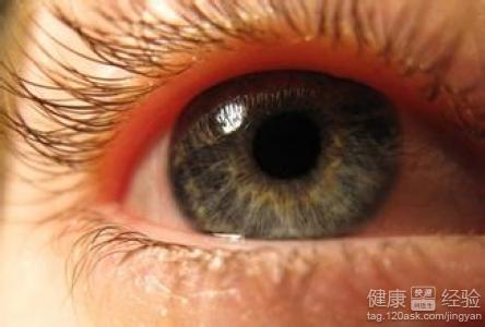 什麼是眼底黃斑變性