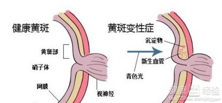 黃斑變性可以順產嗎