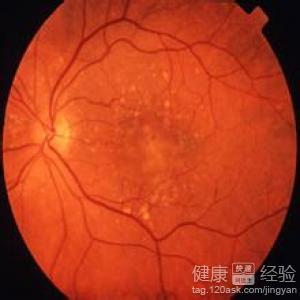 黃斑變性中醫治療