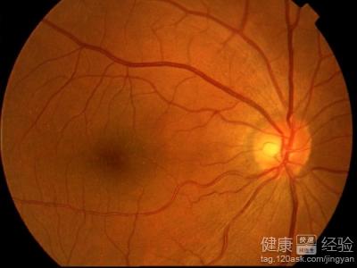 黃斑變性，眼底壞了還能治療麼
