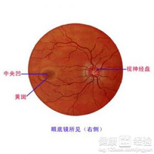 黃斑變性是怎麽回事