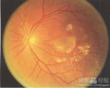 黃斑變性視網膜脫落血壓高能做手術嗎