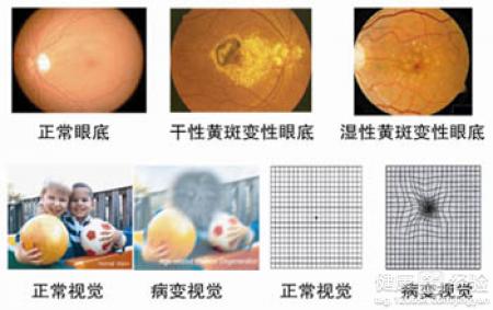 黃斑變性發病一個月早期干預有什麼好辦法