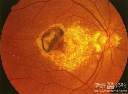 玻璃球後脫離和黃斑變性有什麼危險