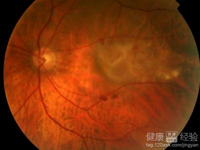 黃斑變性視神經萎縮眼底裂怎麼控制病情