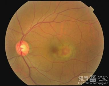 好視力眼貼對黃斑變性有效嗎