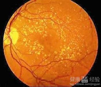 眼底黃斑變性能否手術怎麼判斷