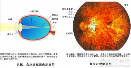 高度近視引起的黃斑變性、神經萎縮的原因