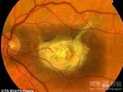 黃斑變性如何治療和一些注意事項