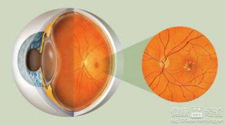 如何治療眼睛的黃斑變性