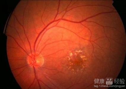 角膜炎能引起黃斑變性嗎