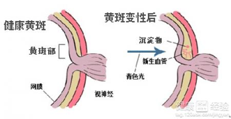 老年性黃斑變性用中醫調理好，還是手術好