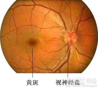 眼底黃斑變性視神經萎縮視力下降和近視有什麼區別