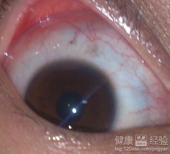 褐色眼球邊緣區域有兩顆黑點是黃斑變性嗎