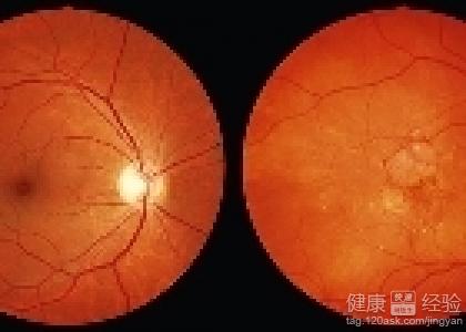 黃斑變性視網膜出血止血藥注意什麼細節