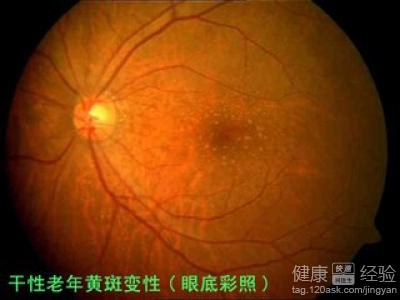 吃葉黃素能否預防老年黃斑變性