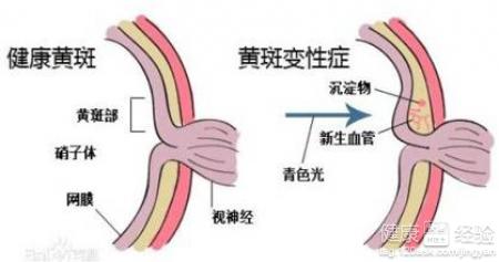 治小兒黃斑變性中西醫結合優勢在哪裡