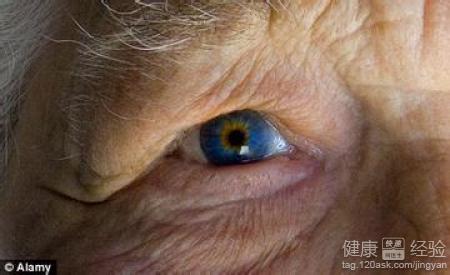老年性黃斑變性是由什麼原因引起的有什麼危害