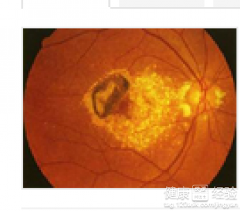 青少年性黃斑變性如何治療