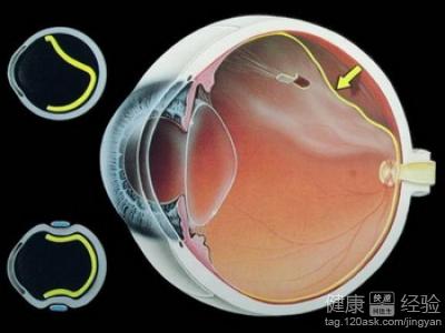 高度近視及眼底黃斑變性如何治療能提高視力