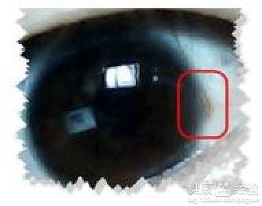 我的眼有黃斑怎麼辦