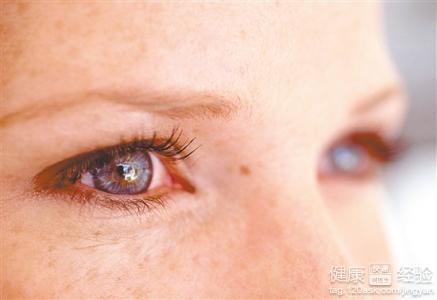 如何預防慢性細菌性結膜炎的發生