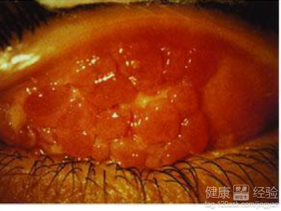 夏季游泳降溫小心患急性結膜炎