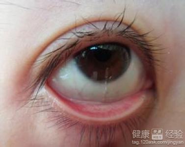 眼睛急性結膜炎的症狀有何表現？