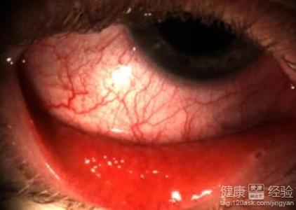 眼球結膜炎的臨床表現有？