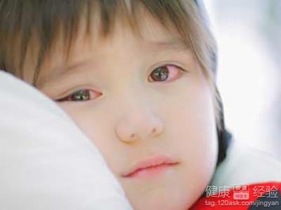 中醫治療小兒眼結膜炎
