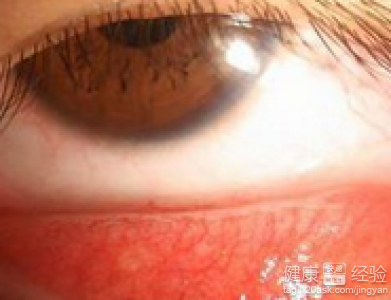 小孩眼結膜炎會傳染嗎？