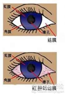 到底眼結膜炎是如何傳染的？